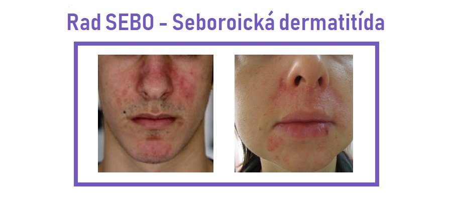 seborea sk